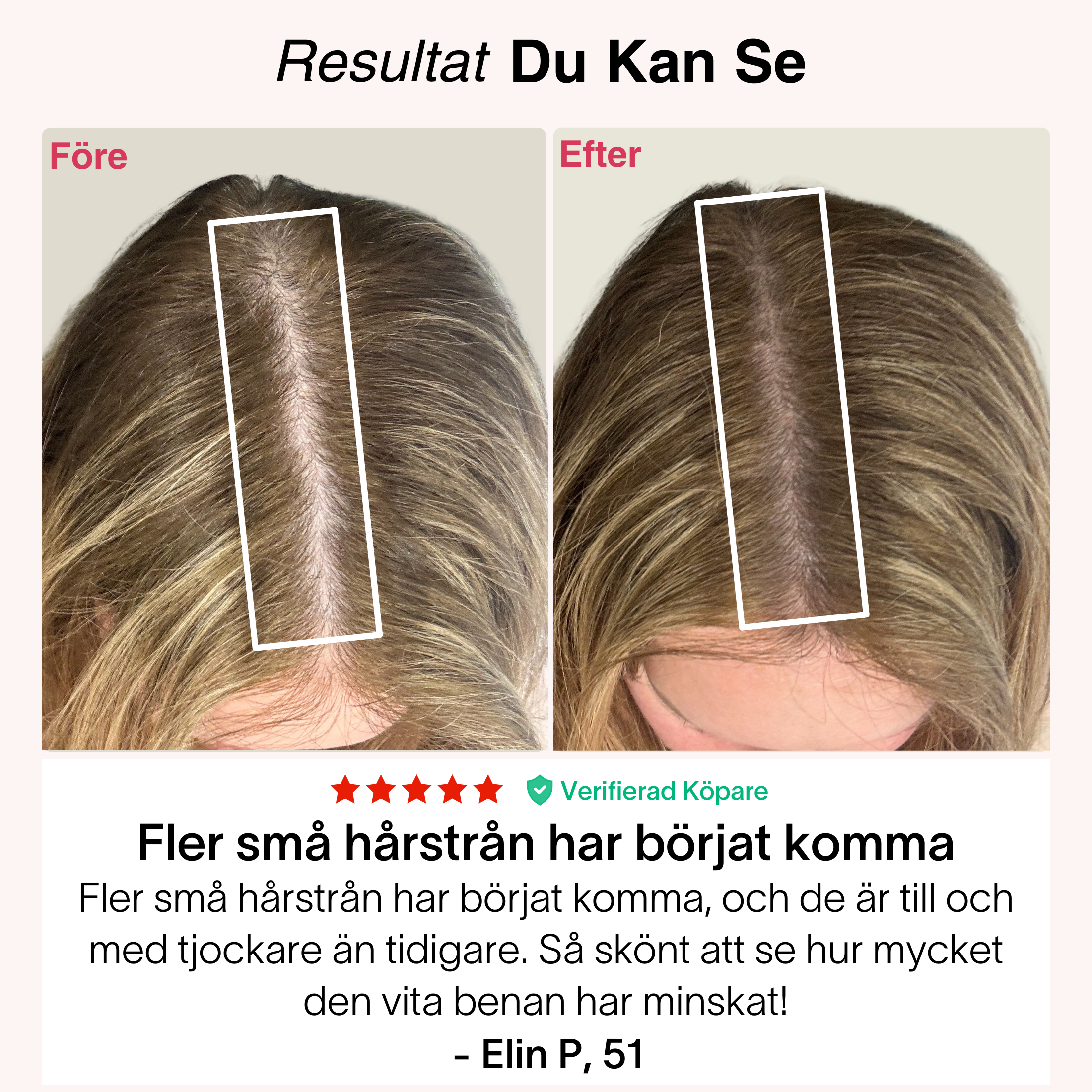 TheraCapX för Håråterväxt