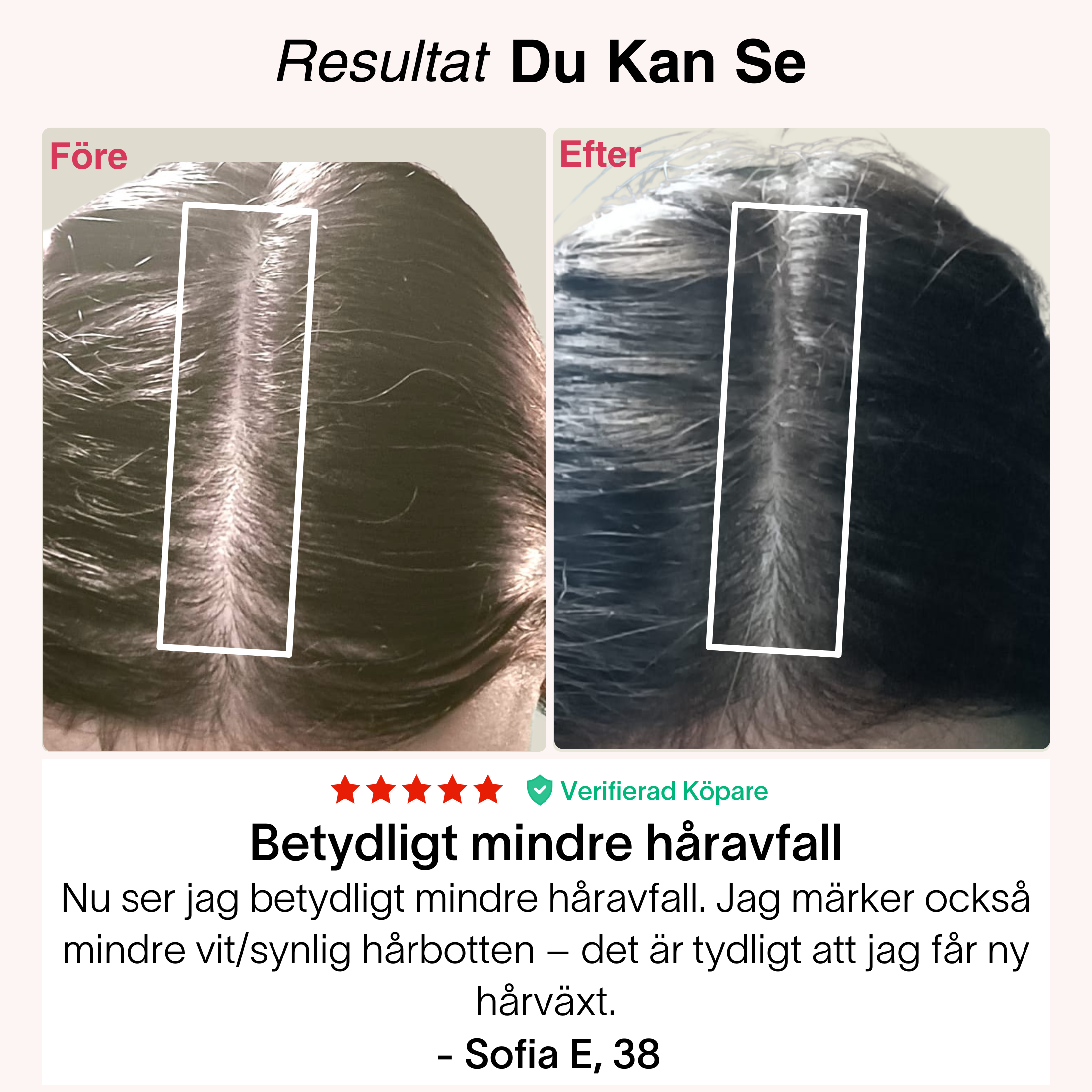 TheraCapX mot håravfall