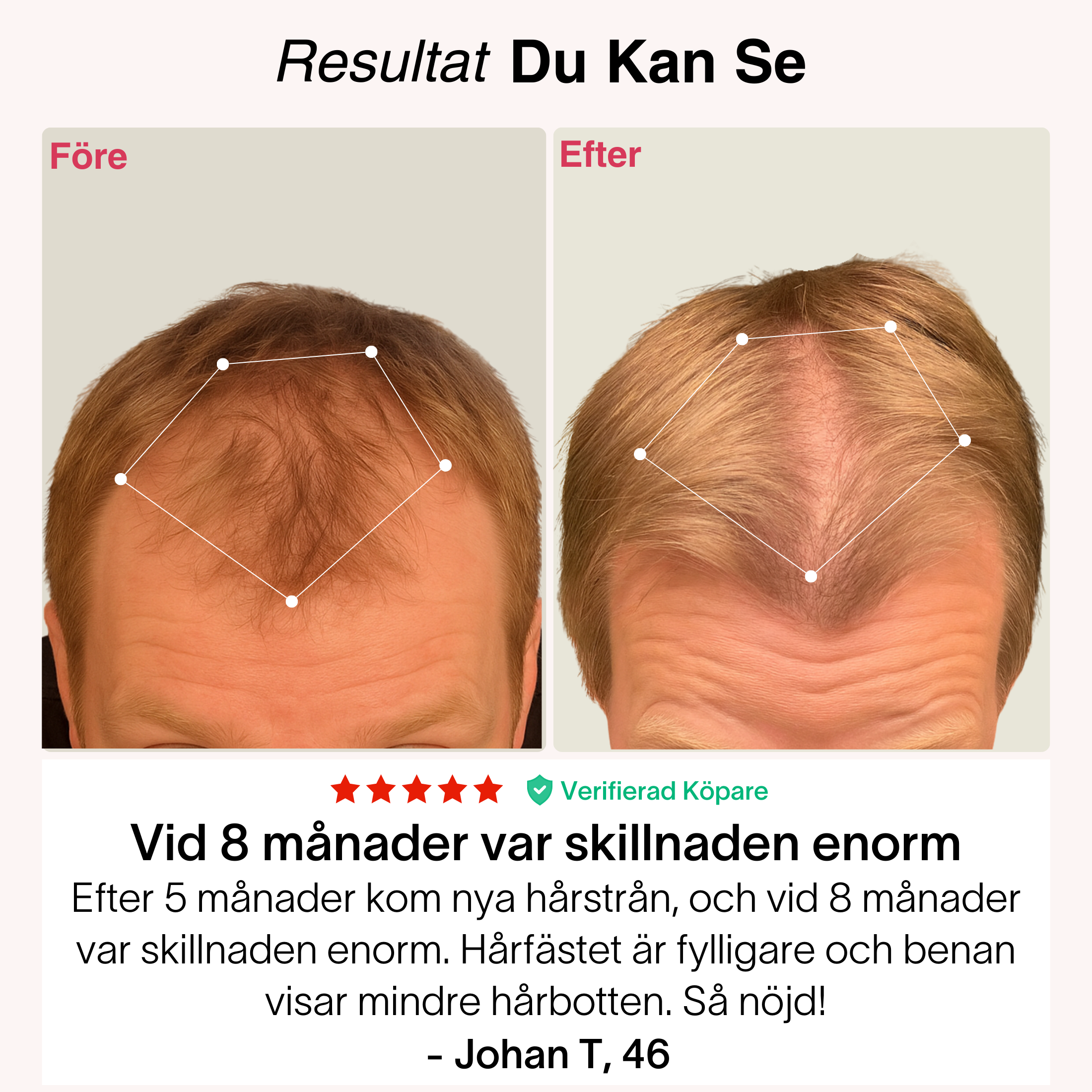 TheraCapX för Håråterväxt