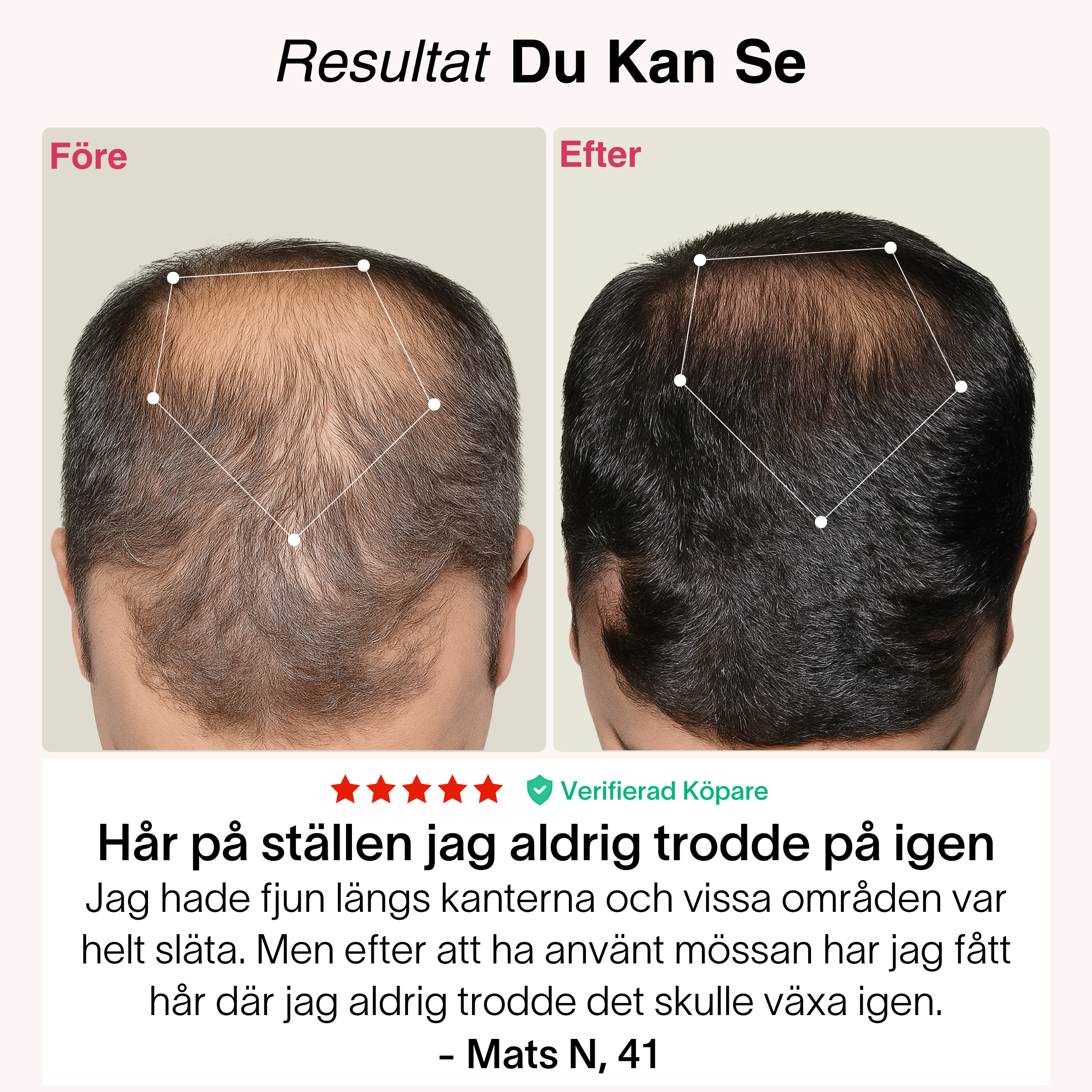 TheraCapX för Håråterväxt